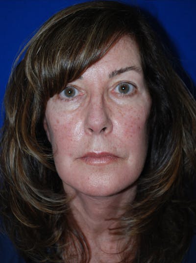 Facelift Before & After Gallery - Patient 309580 - Image 2
