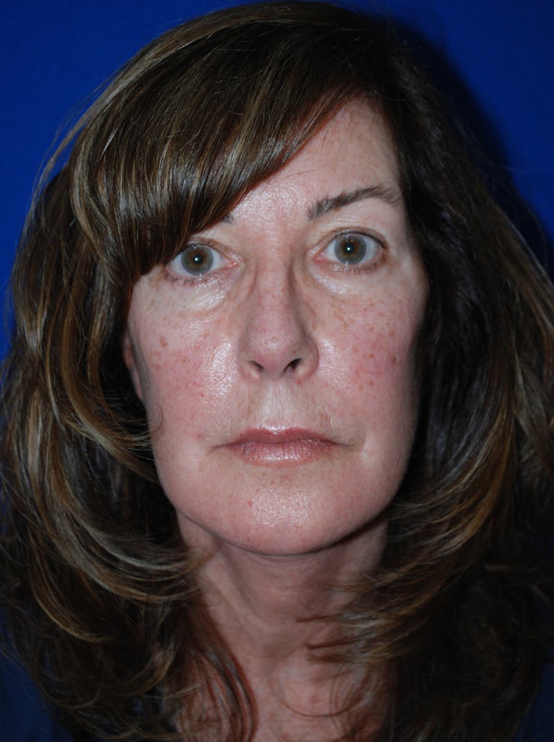 Facelift Before & After Gallery - Patient 309580 - Image 2