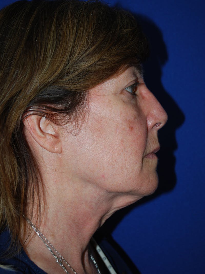 Facelift Before & After Gallery - Patient 309580 - Image 3