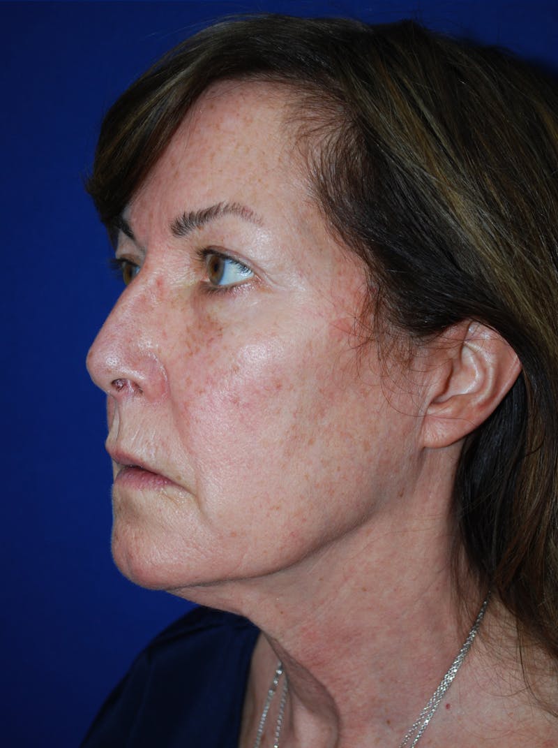 Facelift Before & After Gallery - Patient 309580 - Image 5