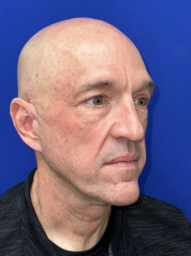 Facelift Before & After Gallery - Patient 200828 - Image 4
