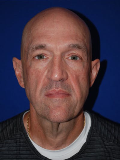Facelift Before & After Gallery - Patient 200828 - Image 1