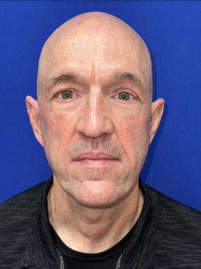 Facelift Before & After Gallery - Patient 200828 - Image 2