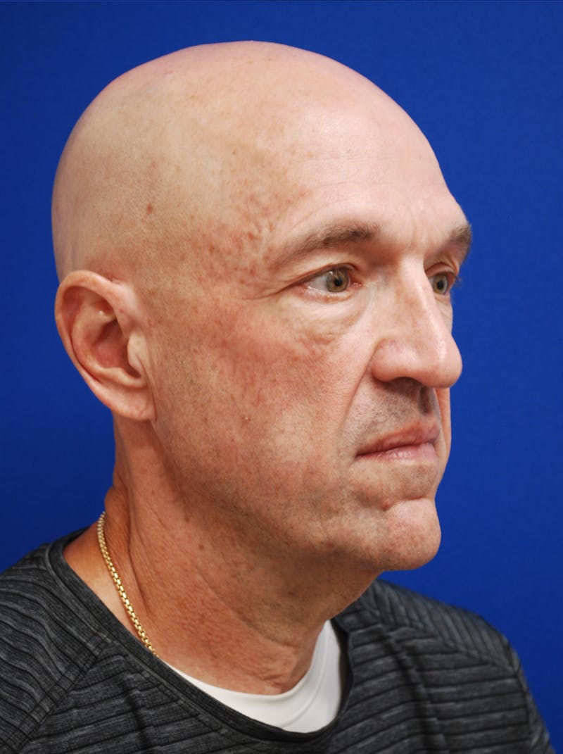 Facelift Before & After Gallery - Patient 200828 - Image 3