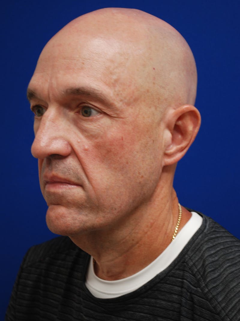 Facelift Before & After Gallery - Patient 200828 - Image 5