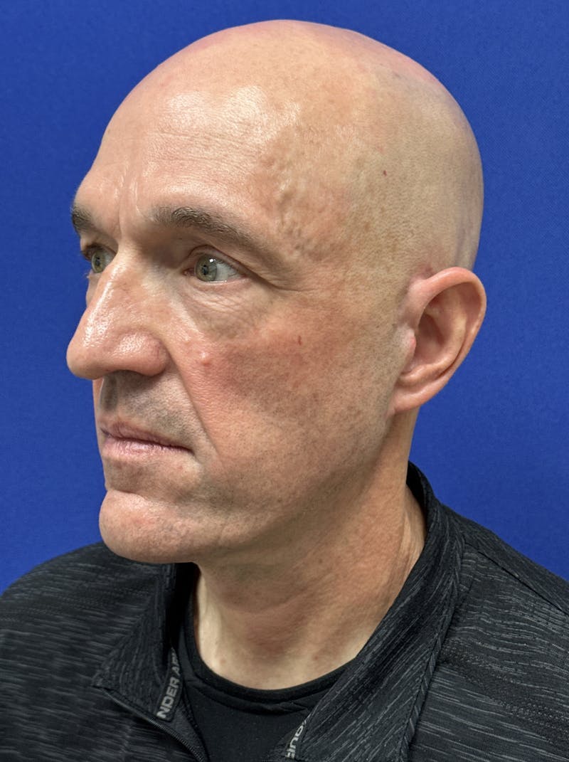 Facelift Before & After Gallery - Patient 200828 - Image 6