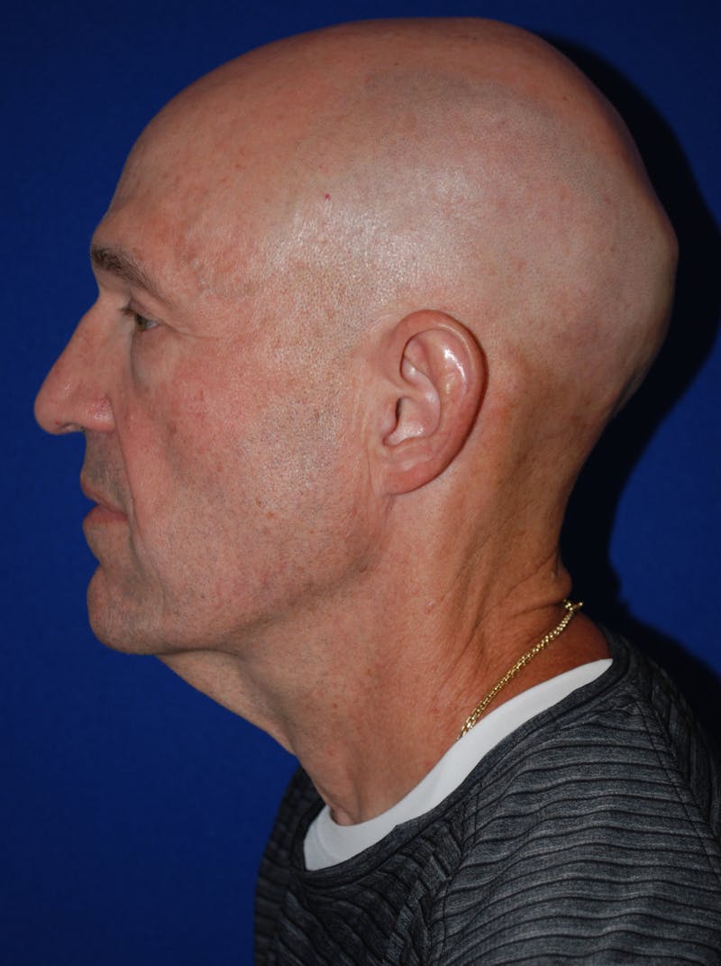 Facelift Before & After Gallery - Patient 200828 - Image 7