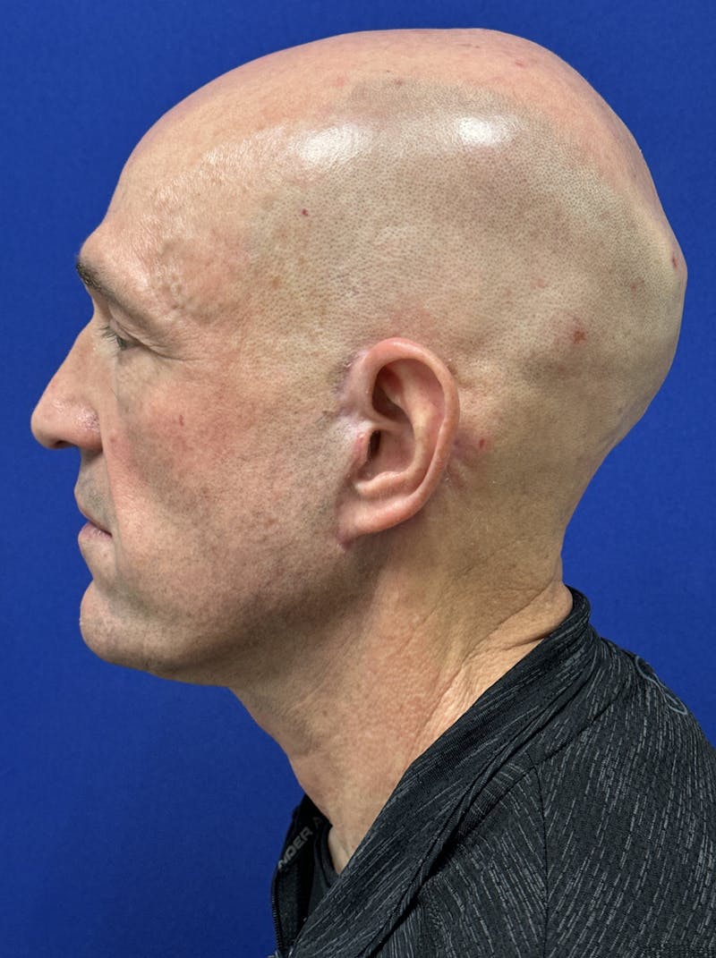 Facelift Before & After Gallery - Patient 200828 - Image 8