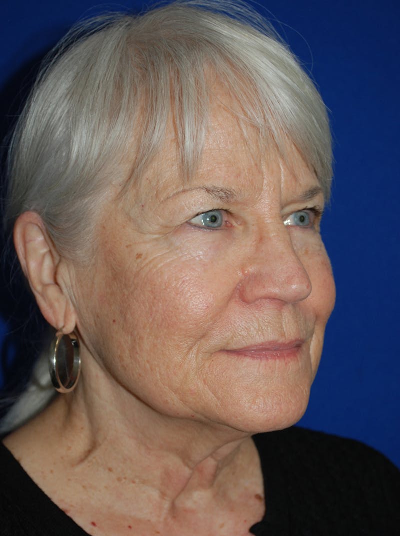 Facelift Before & After Gallery - Patient 559667 - Image 3