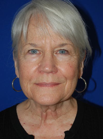 Facelift Before & After Gallery - Patient 559667 - Image 1