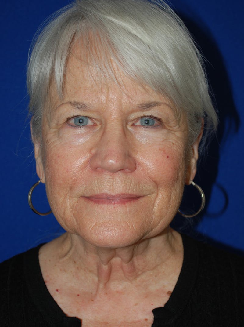 Facelift Before & After Gallery - Patient 559667 - Image 1