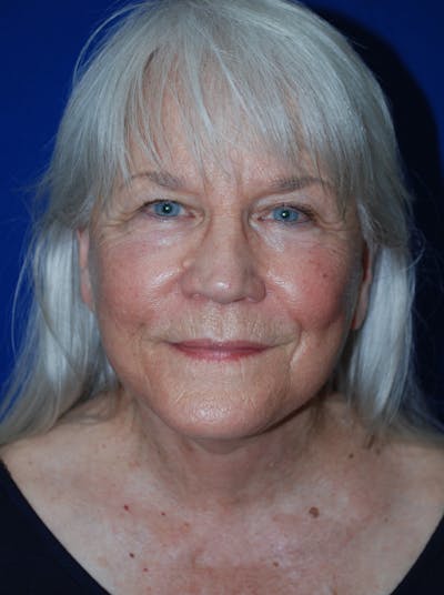Facelift Before & After Gallery - Patient 559667 - Image 2