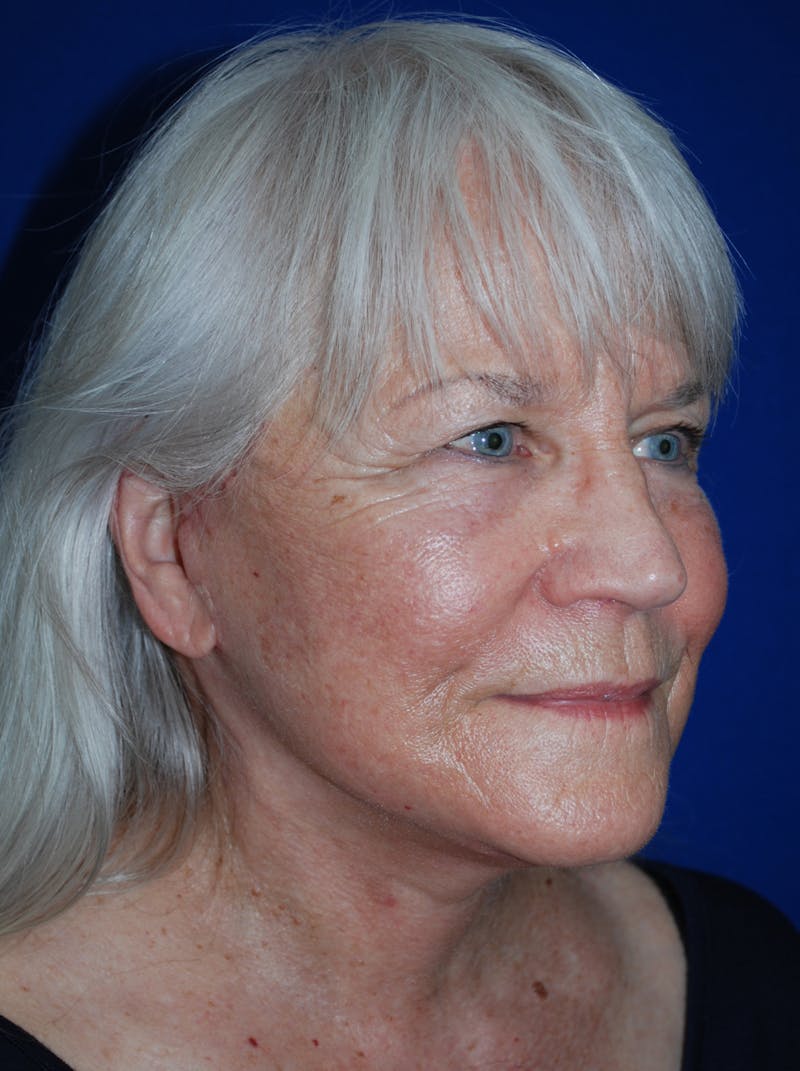 Facelift Before & After Gallery - Patient 559667 - Image 4