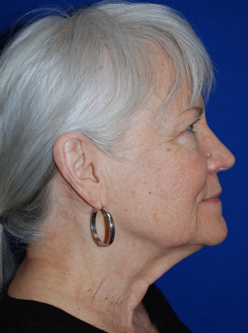 Facelift Before & After Gallery - Patient 559667 - Image 5