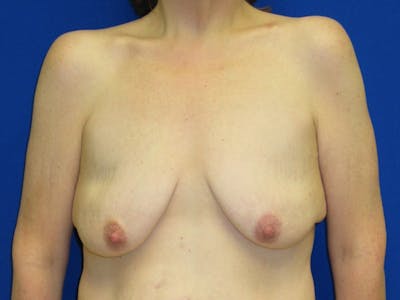 Breast Before & After Gallery - Patient 199515 - Image 1
