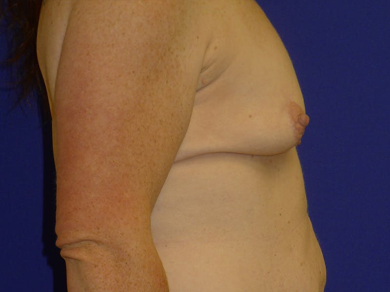 Breast Before & After Gallery - Patient 116796 - Image 3