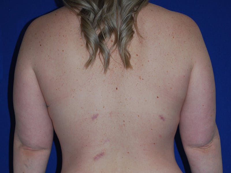 Breast Before & After Gallery - Patient 312172 - Image 6