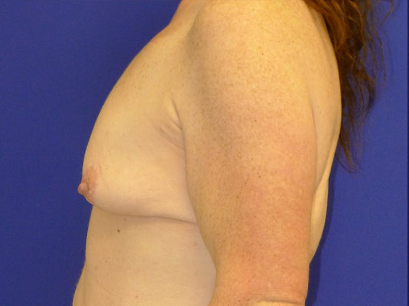 Breast Before & After Gallery - Patient 116796 - Image 5