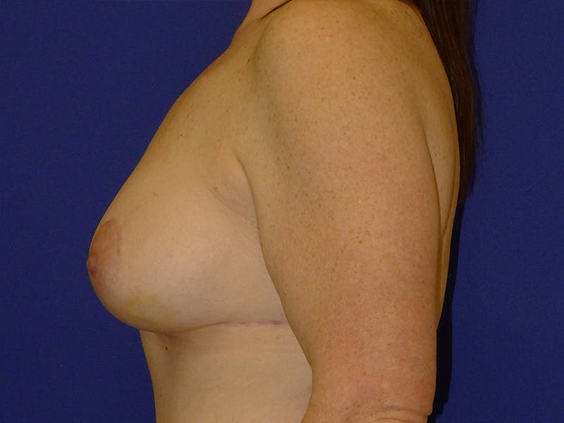 Breast Before & After Gallery - Patient 116796 - Image 6
