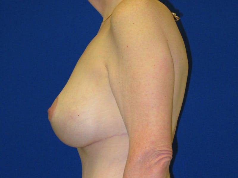 Breast Before & After Gallery - Patient 199515 - Image 6