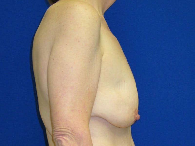 Breast Before & After Gallery - Patient 199515 - Image 3