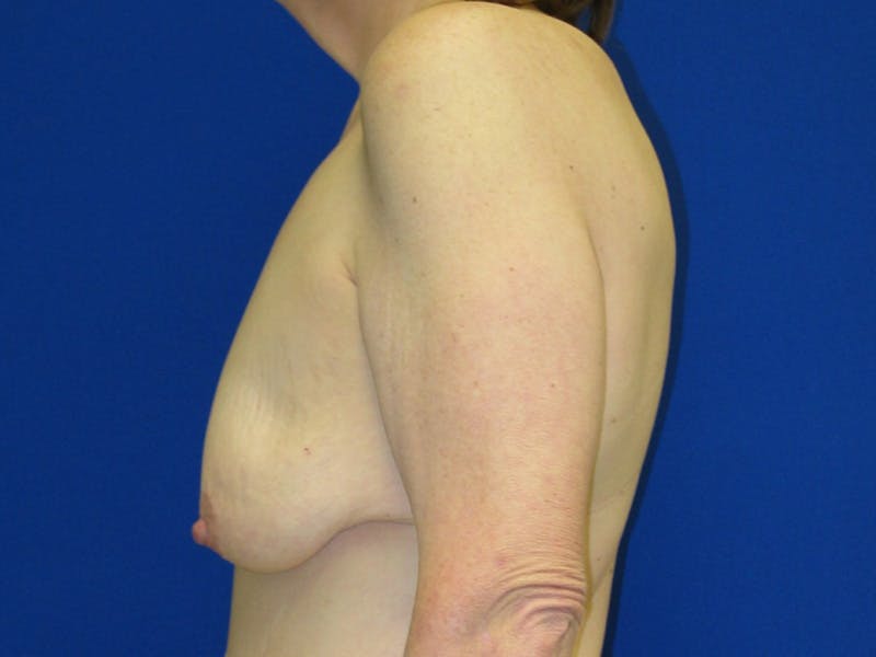 Breast Before & After Gallery - Patient 199515 - Image 5