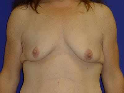 Breast Before & After Gallery - Patient 116796 - Image 1