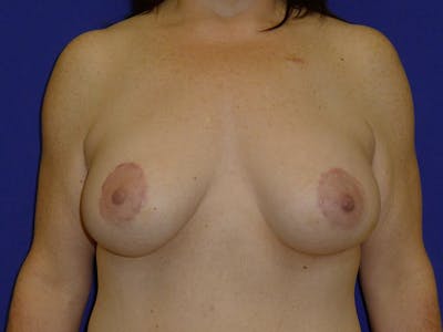 Breast Before & After Gallery - Patient 116796 - Image 2