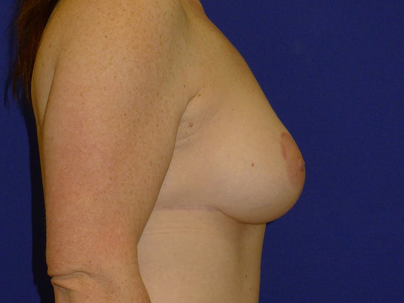 Breast Before & After Gallery - Patient 116796 - Image 4