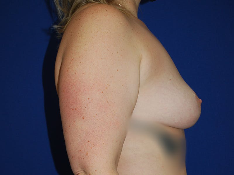 Breast Before & After Gallery - Patient 312172 - Image 4