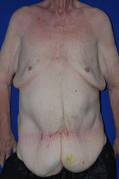 Extended Abdominoplasty Before & After Gallery - Patient 109097 - Image 1
