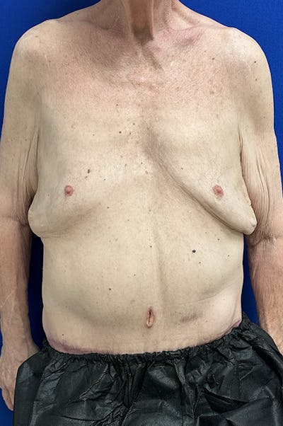Extended Abdominoplasty Before & After Gallery - Patient 109097 - Image 2