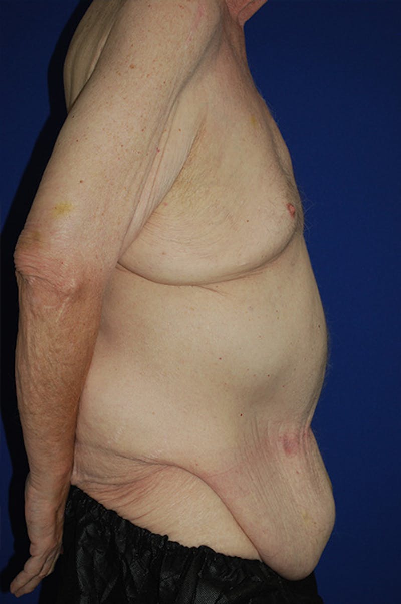 Extended Abdominoplasty Before & After Gallery - Patient 109097 - Image 3