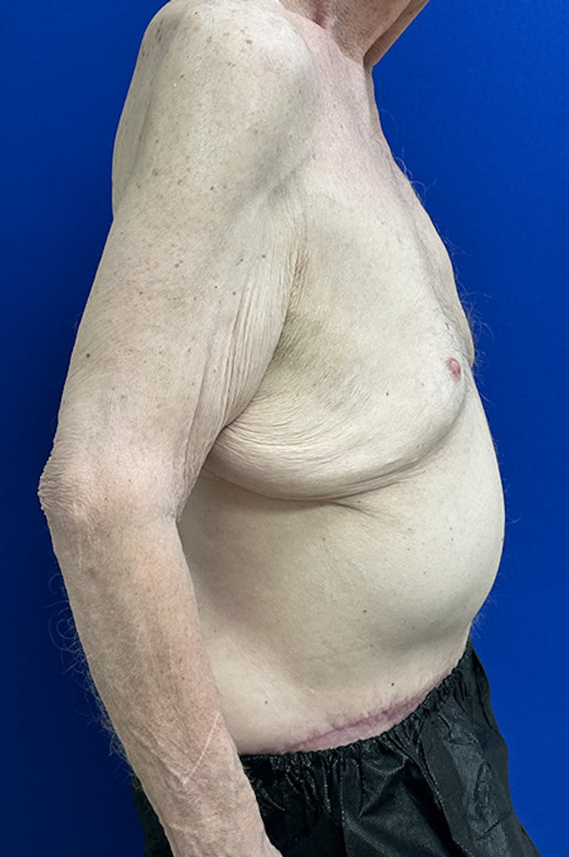 Extended Abdominoplasty Before & After Gallery - Patient 109097 - Image 4
