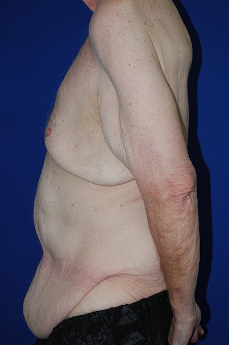 Extended Abdominoplasty Before & After Gallery - Patient 109097 - Image 5