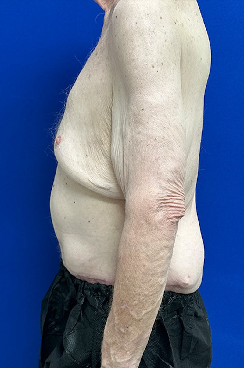 Extended Abdominoplasty Before & After Gallery - Patient 109097 - Image 6