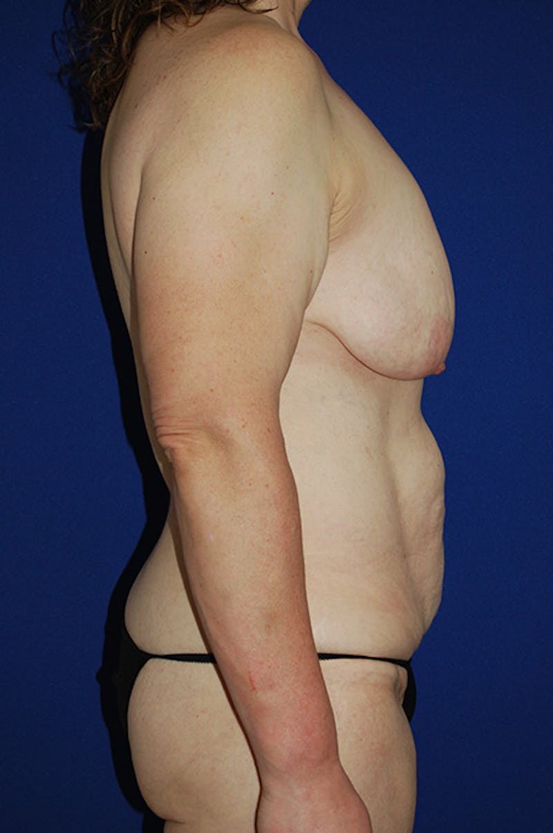 Extended Abdominoplasty Before & After Gallery - Patient 940971 - Image 3