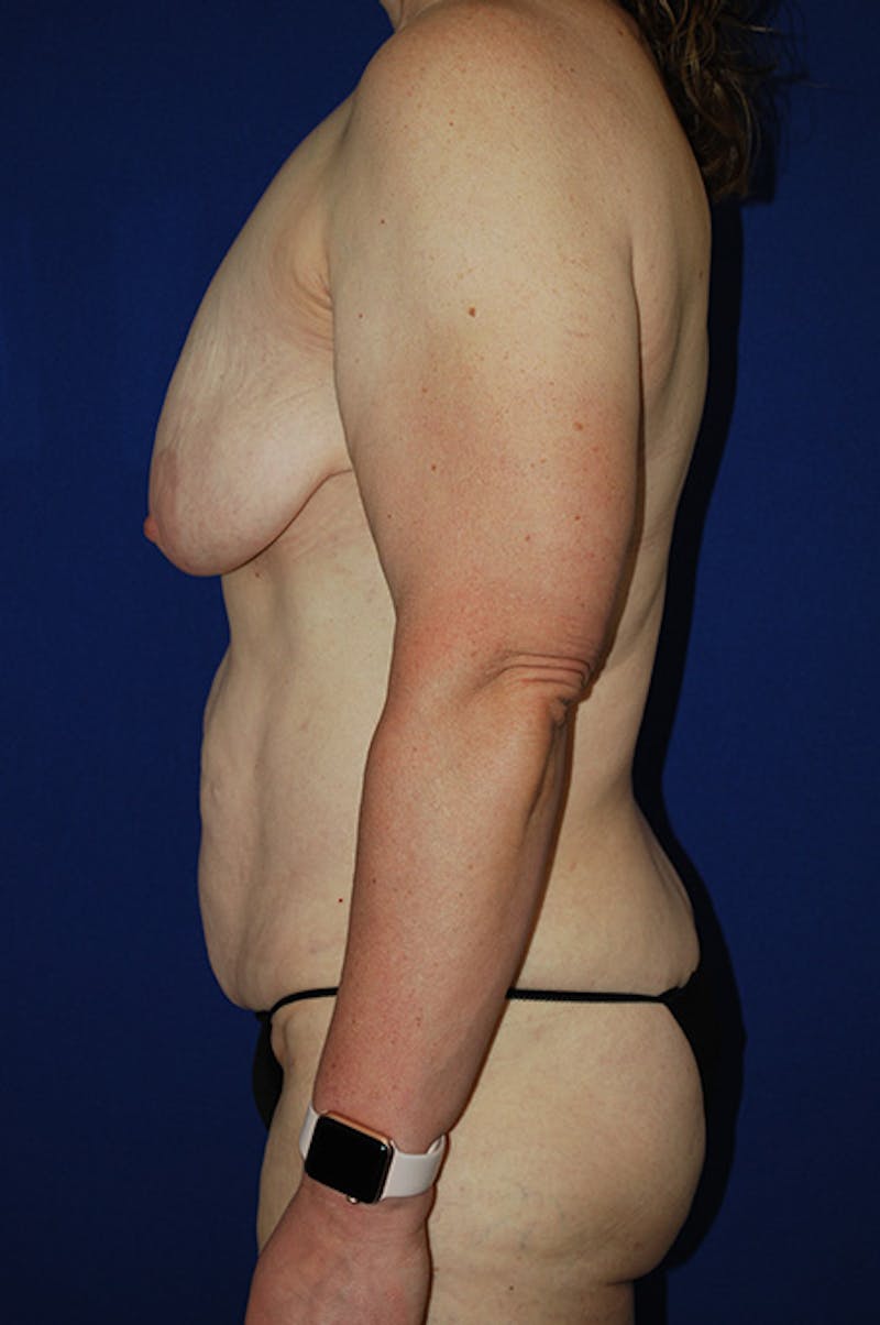 Extended Abdominoplasty Before & After Gallery - Patient 940971 - Image 5