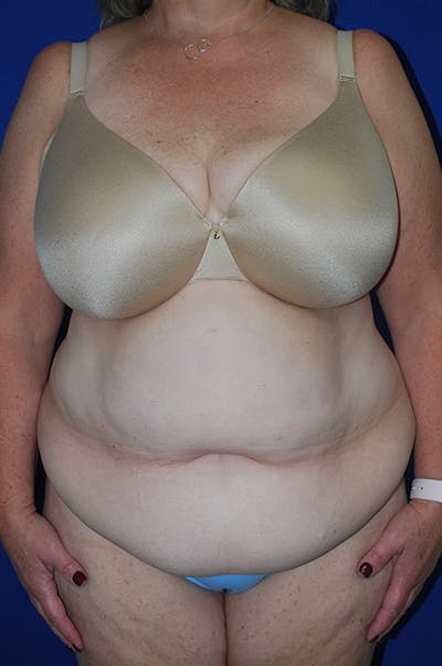 Extended Abdominoplasty Before & After Gallery - Patient 243625 - Image 1