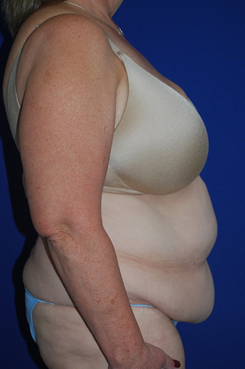 Extended Abdominoplasty Before & After Gallery - Patient 243625 - Image 3