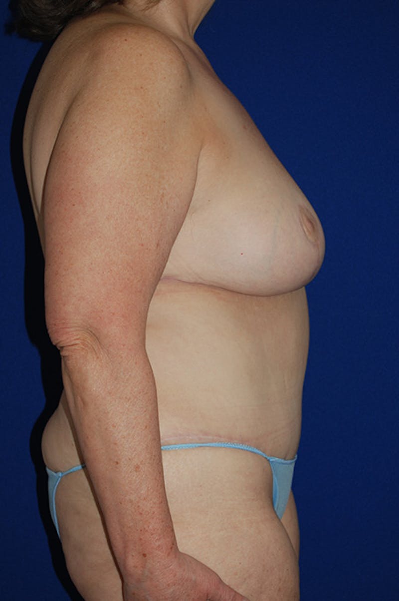 Extended Abdominoplasty Before & After Gallery - Patient 243625 - Image 4