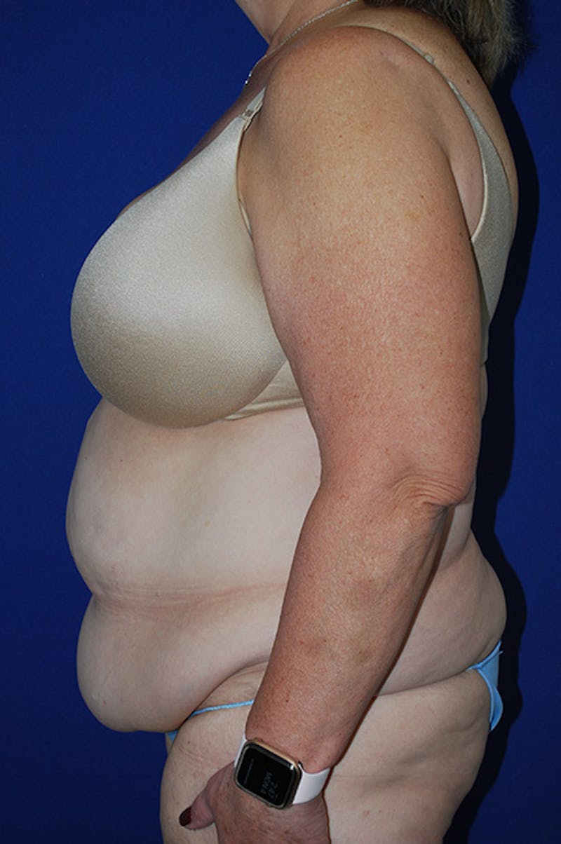Extended Abdominoplasty Before & After Gallery - Patient 243625 - Image 5