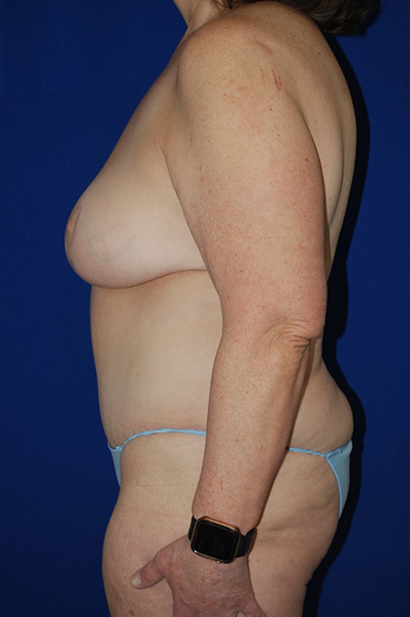 Extended Abdominoplasty Before & After Gallery - Patient 243625 - Image 6