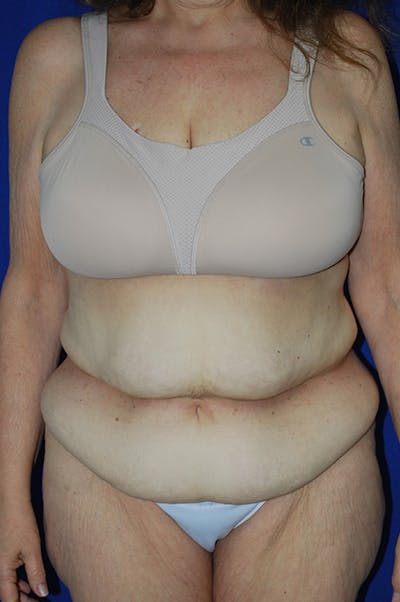 Extended Abdominoplasty Before & After Gallery - Patient 300294 - Image 1