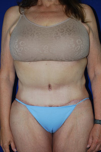 Extended Abdominoplasty Before & After Gallery - Patient 300294 - Image 2