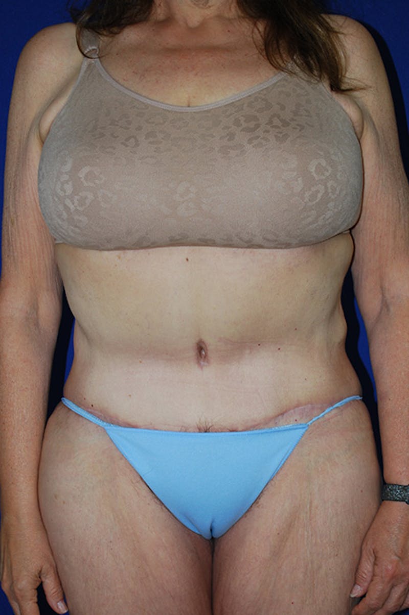 Extended Abdominoplasty Before & After Gallery - Patient 300294 - Image 2