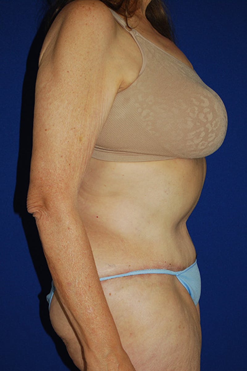 Extended Abdominoplasty Before & After Gallery - Patient 300294 - Image 4