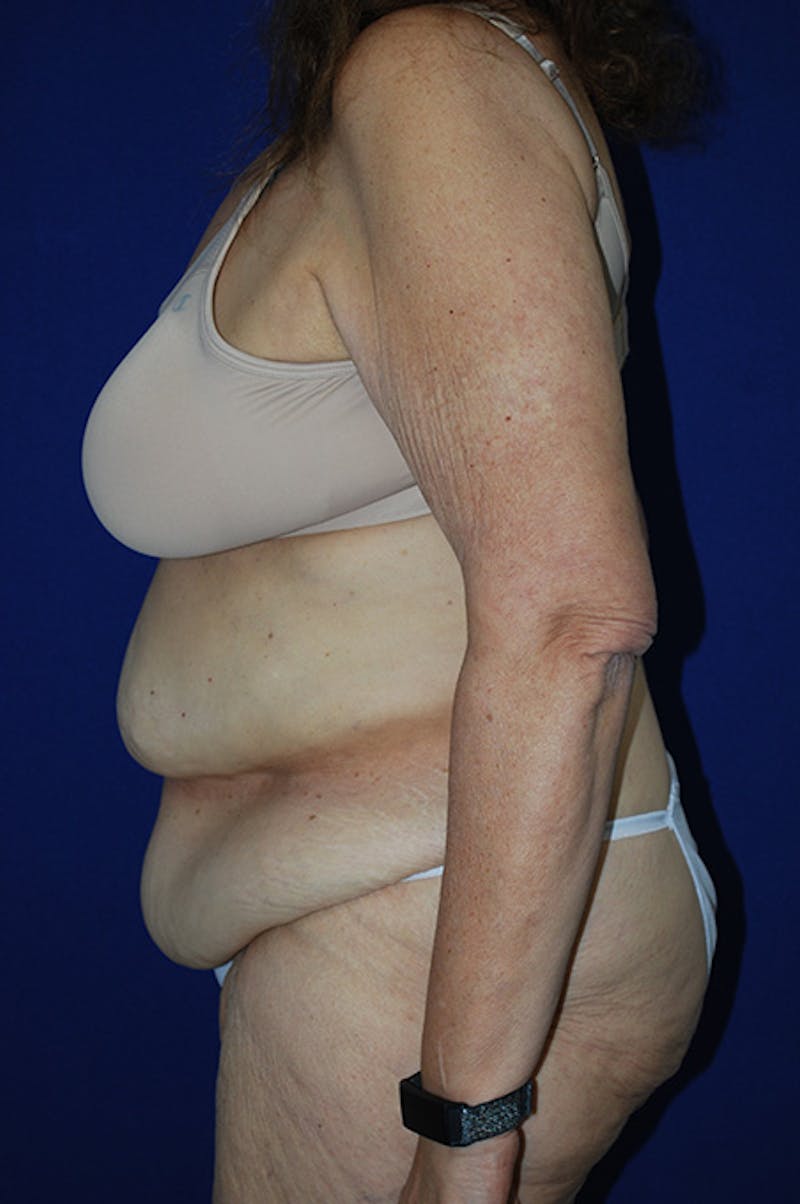 Extended Abdominoplasty Before & After Gallery - Patient 300294 - Image 5