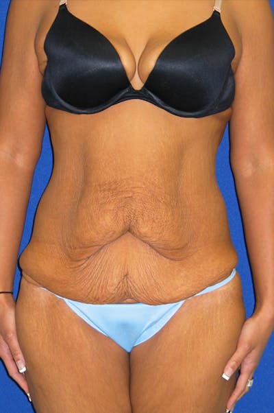 Extended Abdominoplasty Before & After Gallery - Patient 135288 - Image 1