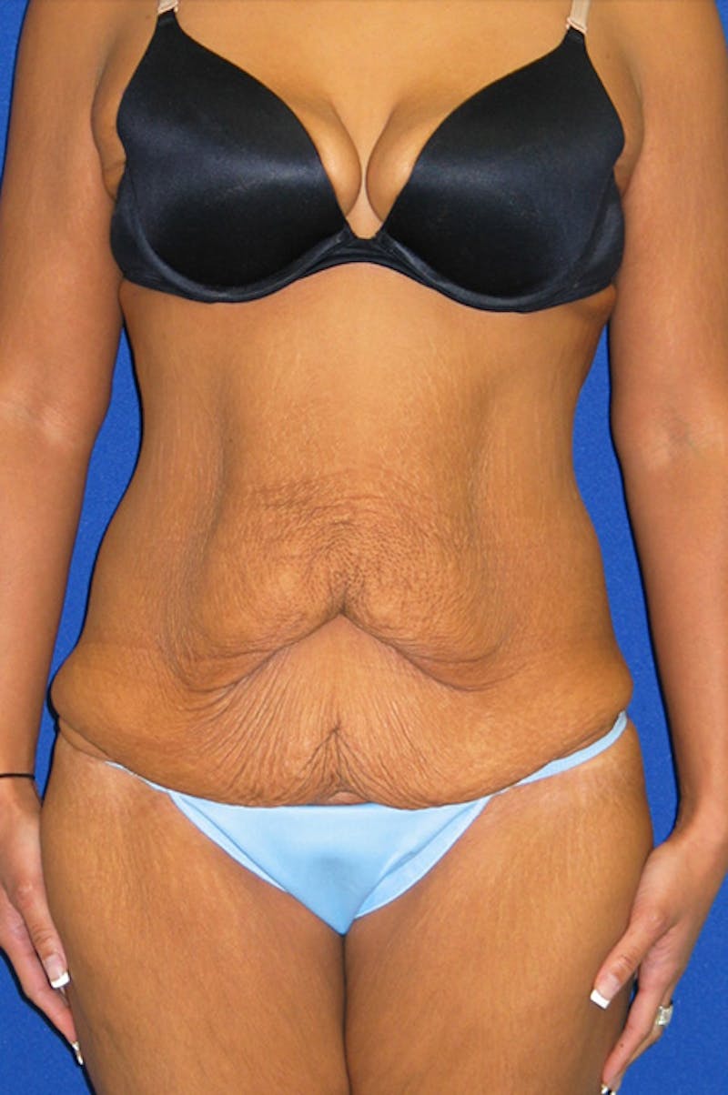 Extended Abdominoplasty Before & After Gallery - Patient 135288 - Image 1